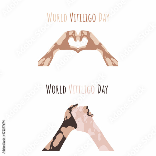 Hands with vitiligo disease. Support for people with skin pigmentation disorders. Heart and body positive. Different skin colors and nationalities. Body positive. Hand drawn illustration. Vector