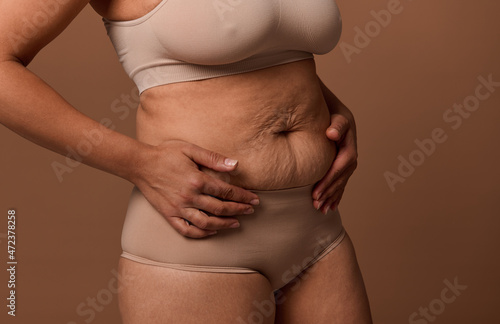 Woman body with stretch marks on the skin after childbirth. The concept of love and acceptance of yourself and your body. Body positive photo