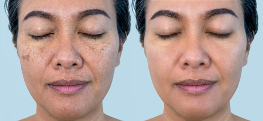 Retouched image to show before and after treatment spot melasma pigmentation facial treatment on young asian woman face. Skincare and health problem concept.	