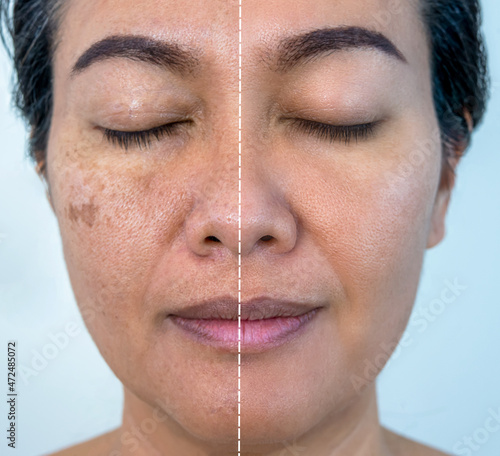 Retouched image to show before and after treatment spot melasma pigmentation facial treatment on young asian woman face. Skincare and health problem concept.	