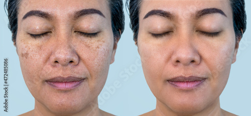 Retouched image to show before and after treatment spot melasma pigmentation facial treatment on young asian woman face. Skincare and health problem concept.	
