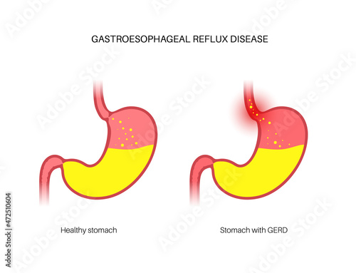 Gastroesophageal reflux disease
