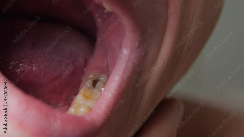 Sick tooth closeup mans mouth Sick tooth closeup mans mouth