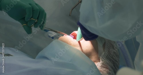 The surgeon and the assistant remove the wisdom teeth of the patient under general anesthesia in the department of surgical dentistry. Tooth extraction. Bone grafting, installation of dental implants