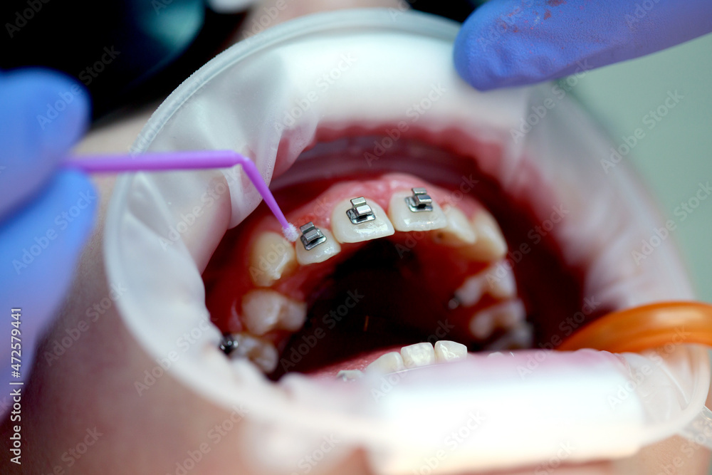 Installation of braces on the upper teeth. Treatment by an orthodontist