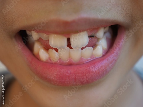 Kid patient open mouth showing cavities teeth decay. Caused by unclean brushing, eating candy. Concepts about oral health. closeup photo, blurred.