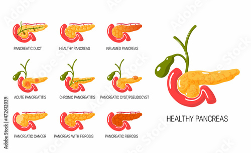 Pancreas diseases concept in flat style, vector