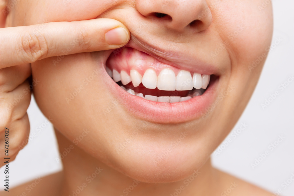 © Марина Демешко - Gum health. Cropped shot of a young woman showing healthy gums isolated on a white background. Dentistry, dental care