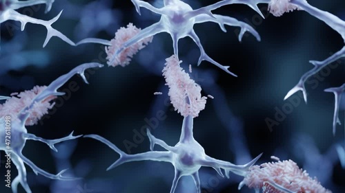 Amyloid plaque forming between neurons in Alzheimer disease	