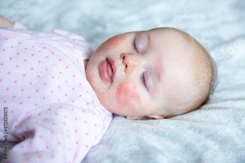 Little girl with atopic dermatitis on face photo