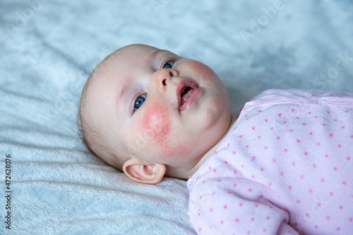 Newborn baby girl with red skin rash, dermatitics syndrom