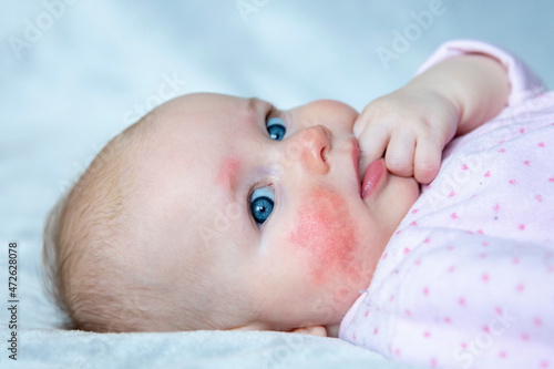 Newborn baby face with allergic reaction on skin.