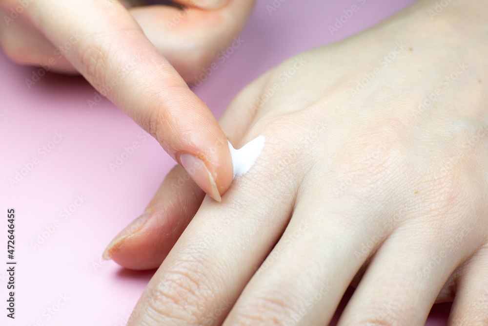 Woman applying hands cream. Irritated, problem skin of hands. Dermatology concept. Close up. Woman applying hands cream. Irritated, problem skin of hands. Dermatology concept. Close up.