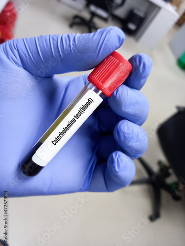 Scientist hold blood sample for Catecholamine hormone(blood) test, the test to check for adrenal tumors in adults. dopamine, norepinephrine, epinephrine tests.