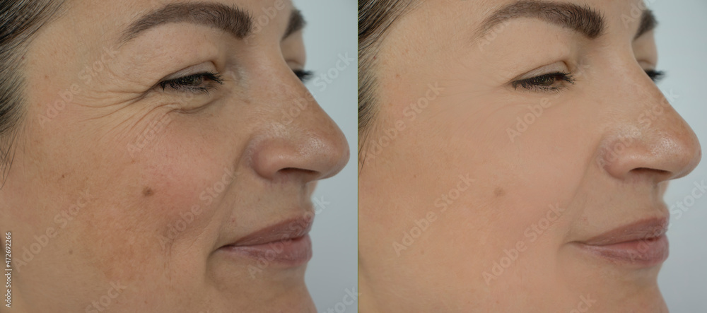 Obraz premium woman face wrinkles before and after treatment