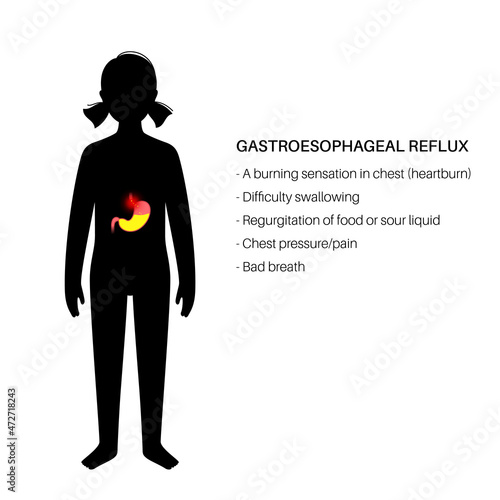 Gastroesophageal reflux disease