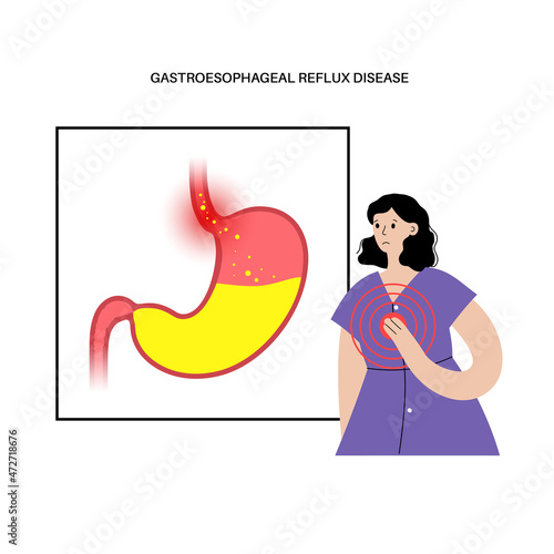 Gastroesophageal reflux disease