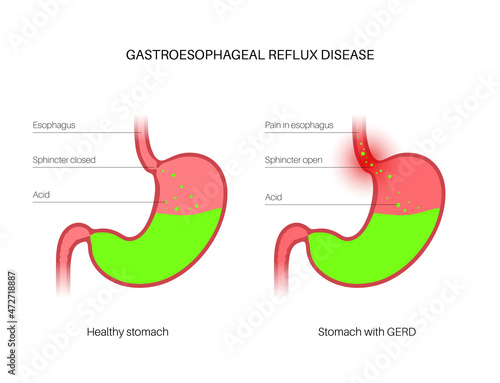 Gastroesophageal reflux disease