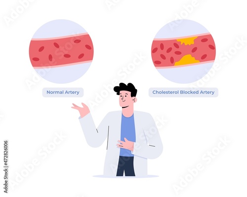 A doctor explained about normal and cholesterol blocked artery