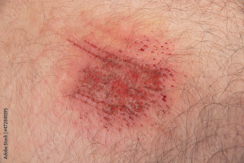 Close up of an abrasion wound in Caucasian skin photo