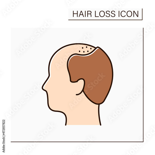 Hair loss color icon. Man loses hair. Male pattern baldness. Large bald area on front of scalp.Alopecia concept. Isolated vector illustration