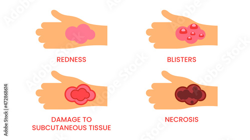 Abstract Flat Doctor Help Types Of Burns First Aid Cartoon People Character Concept Illustration Vector Design Style