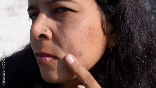 Young Indian Woman face skin problem acne, acne marks, rough ,dull and dry skin issue