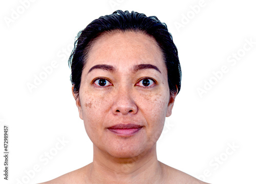 Close up Asian woman face with Problem skincare and health concept. Closeup Asian woman face skin with melasma, Dark spots, pigment and large pores problem. Woman head isolated on white background. photo