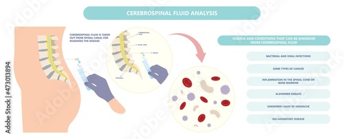 Lumbar puncture for infalmmation Bleeding cancer brain inject anaesthetic diagnosis disease disorder anaesthesia viral encephalitis syphilis