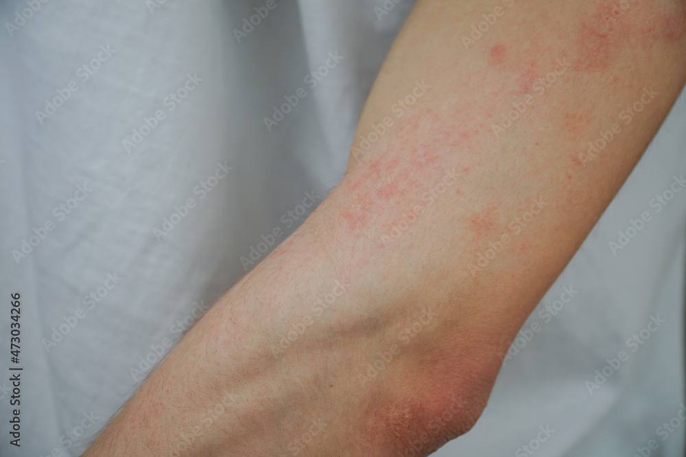 Red rush on the skin of a arm Red rush on the skin of a arm