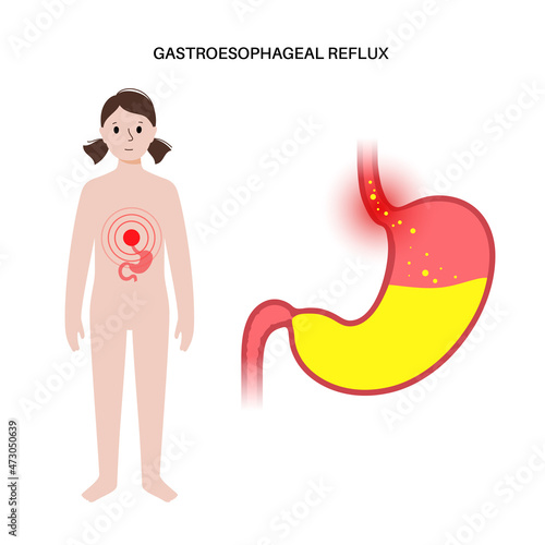 Gastroesophageal reflux disease
