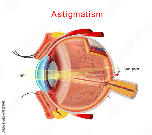Illustration of astigmatism. Astigmatism is a blurred vision. Anatomy of the eye, cross section. Isolated Vector.
