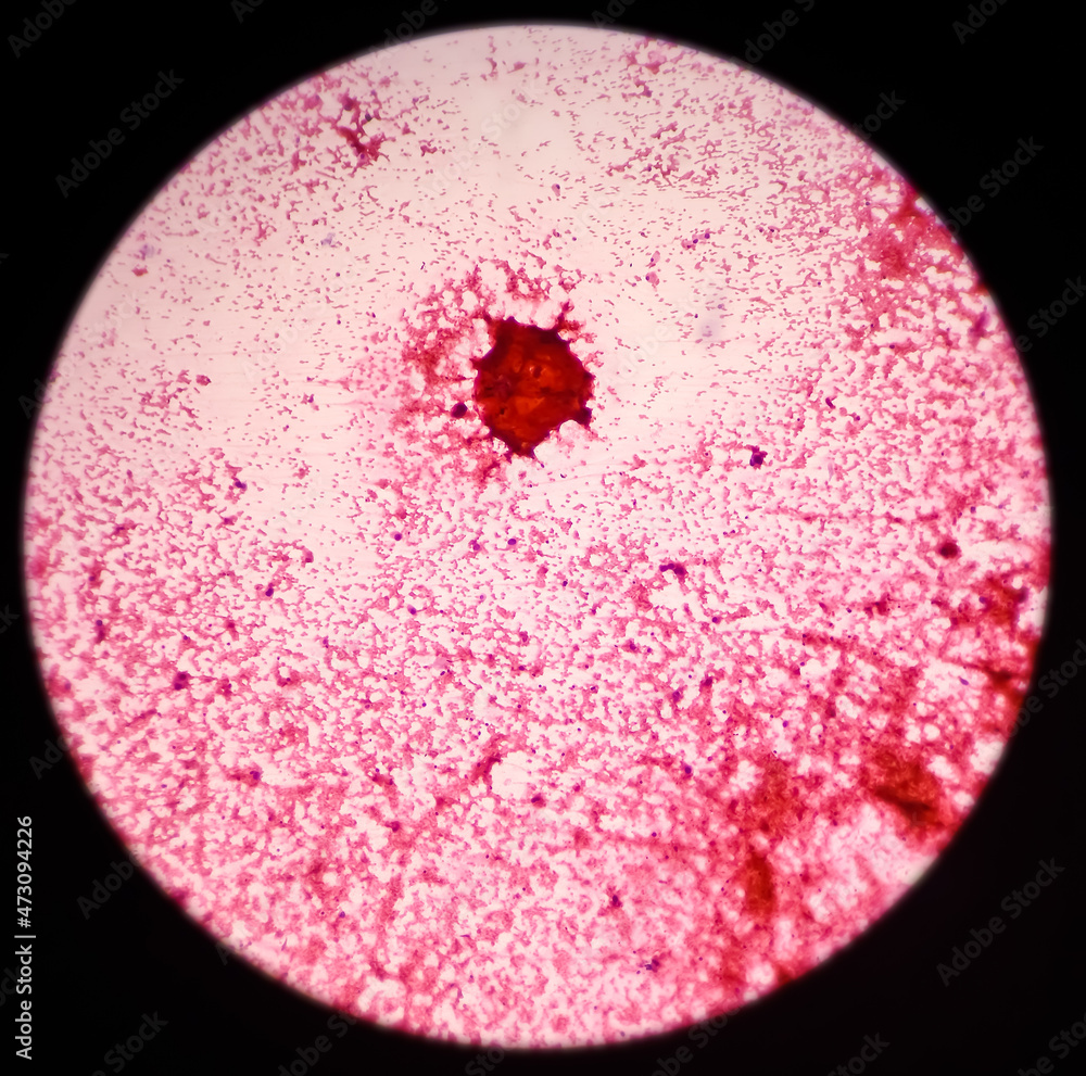 Microscopic view of proliferative breast disease with atypia, show