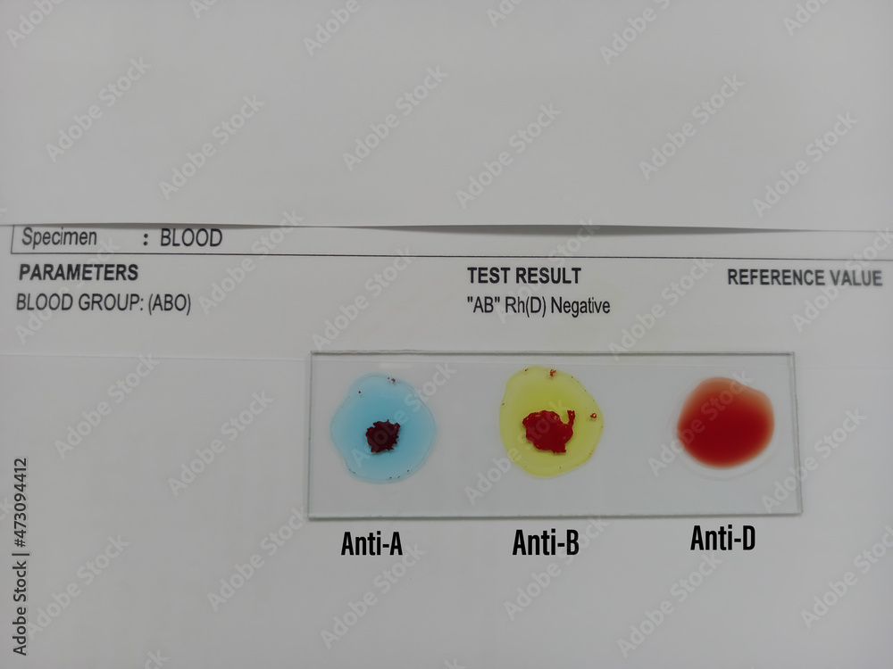 Blood group testing by slide agglutination method with report , AB Negative blood grouping. medical concept Blood group testing by slide agglutination method with report , AB Negative blood grouping. medical concept