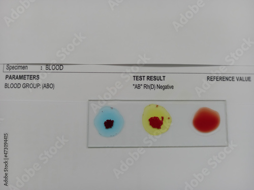 Foto Blood group testing by slide agglutination method with report , AB Negative blood grouping