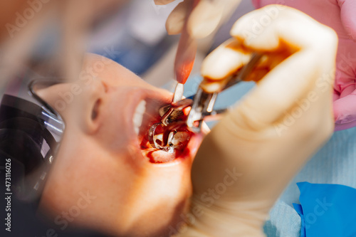 real. dentist pulls out a sick wisdom tooth.  photo