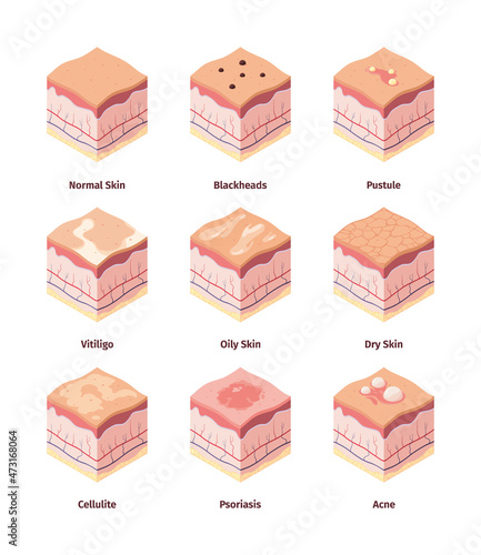 Type of skin. Dermis structure human body cross layers biological illustration cellulite dermatology peles garish vector isometric picture