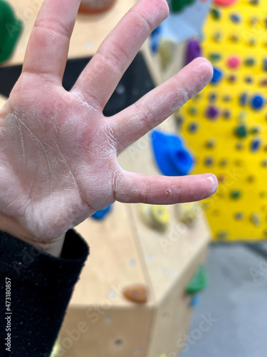 Child injured hand with chalk magnesium after boulder climbing