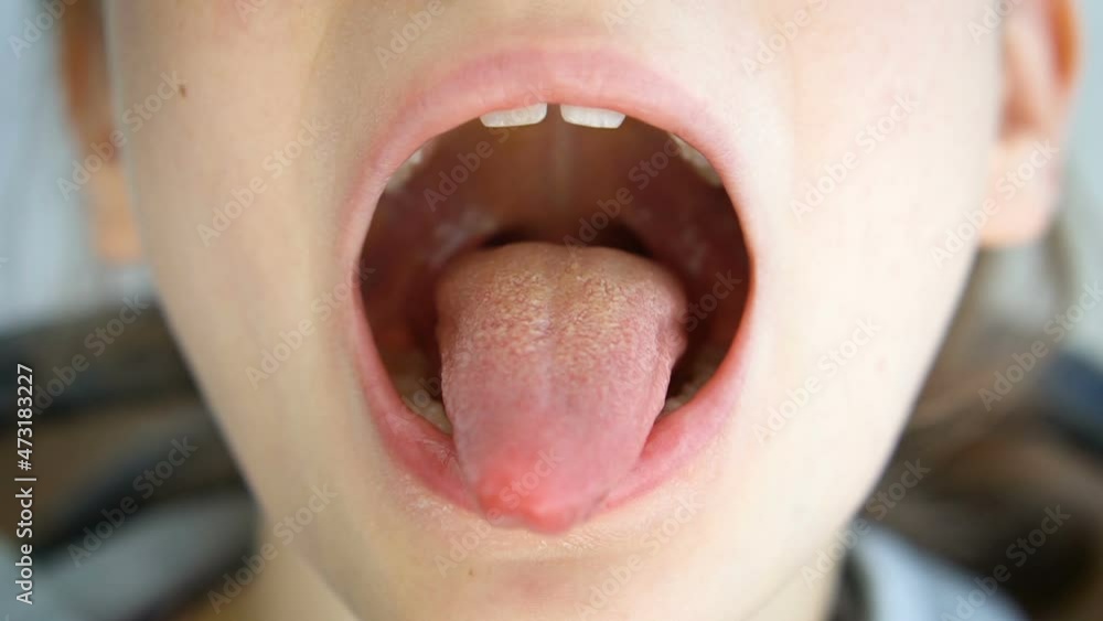Wide open mouth with a tongue stuck out, view of the uvula and the soft