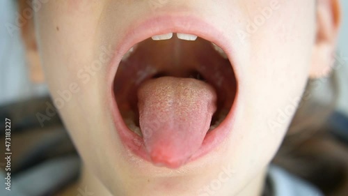 Wide open mouth with a tongue stuck out, view of the uvula and the soft palate of little girl, pediatric dentistry