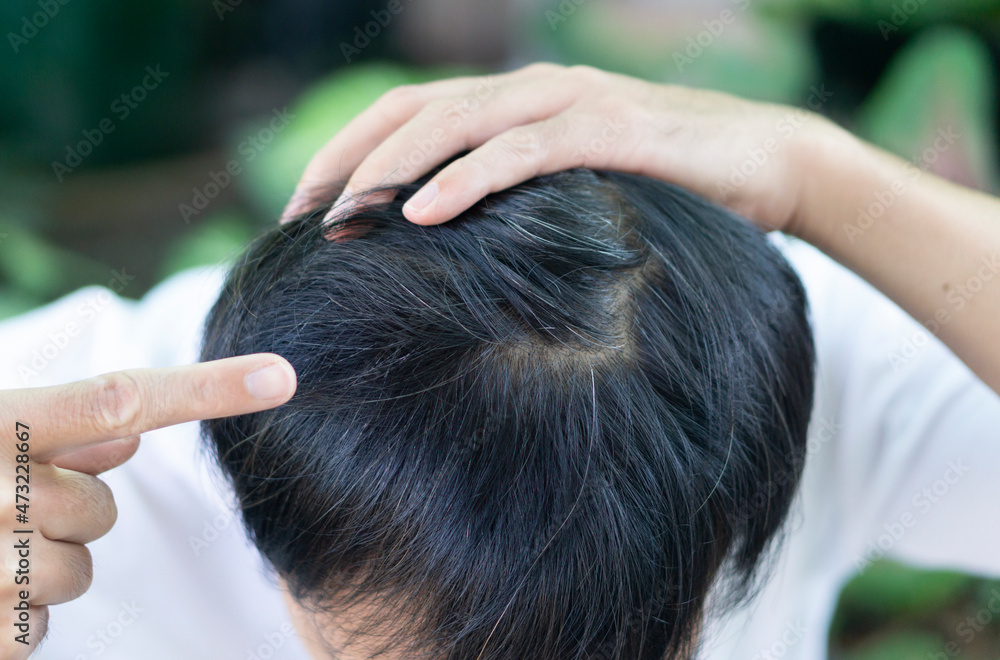 Naklejka premium Closeup young man with gray hair problem with green nature background with copy space, Healthy care concept