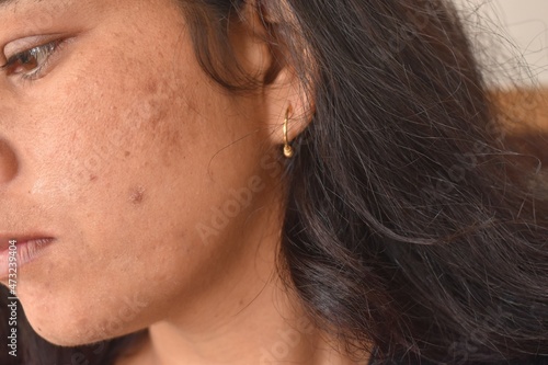 Pimples, Dark spots, freckles, dry skin on face middle age woman, Problem skincare and health concept.