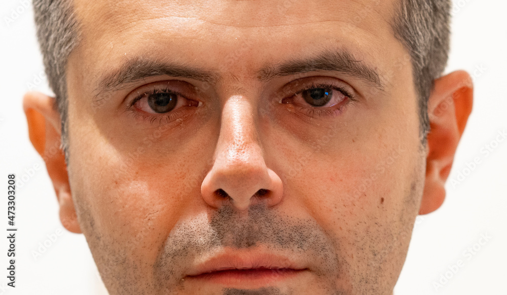 Obraz premium Man with conjunctivitis. Bloody eyes.