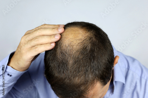 Baldness, man concerned about hair loss. Male hand on a bald top of head