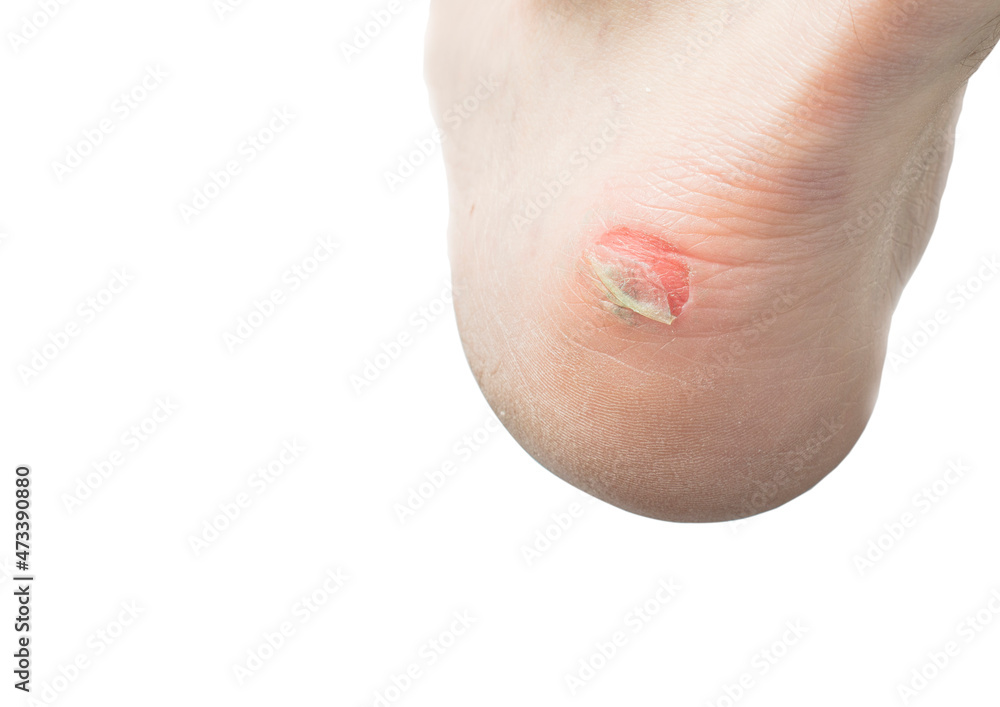 Naklejka premium inflamed dried corn with peeling skin on the heel. white background