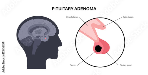 Pituitary adenoma cancer