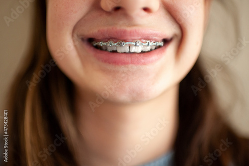 Close up of braces on teeth of a teen girl against blank wall photo