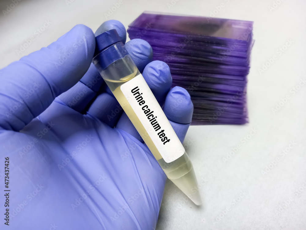 Urine sample for Urine calcium test at medical laboratory, Chronic