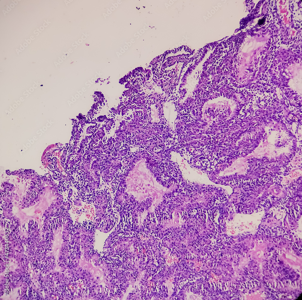 Molar pregnancy(curettage), microscopic image compatible with