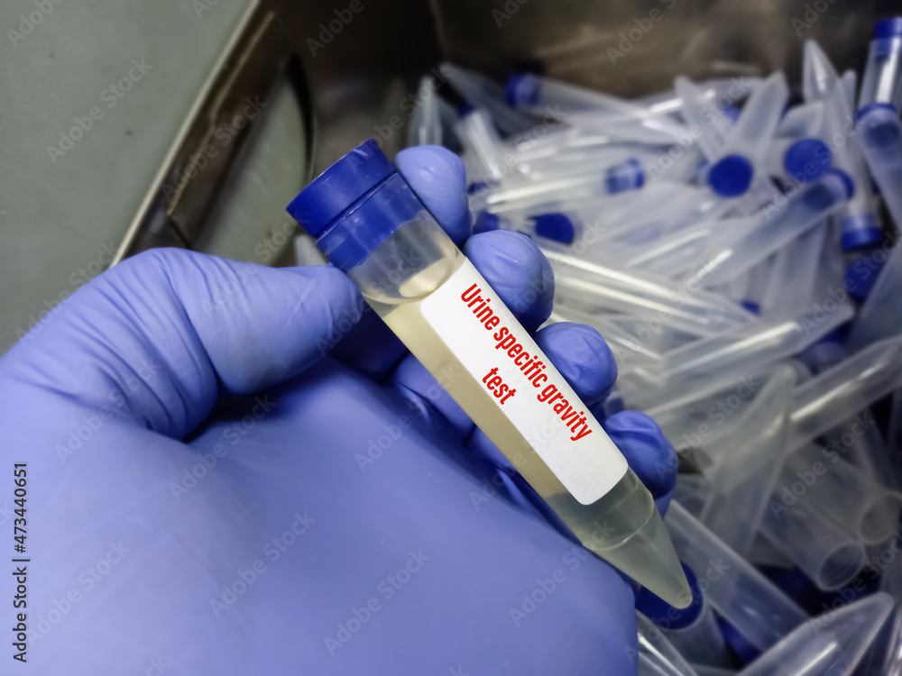 Urine sample for Urine specific gravity test, It can help determine how